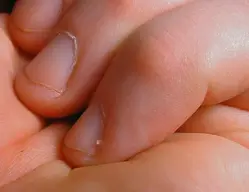 Hangnail_on_left_hand_pinkie_01.webp